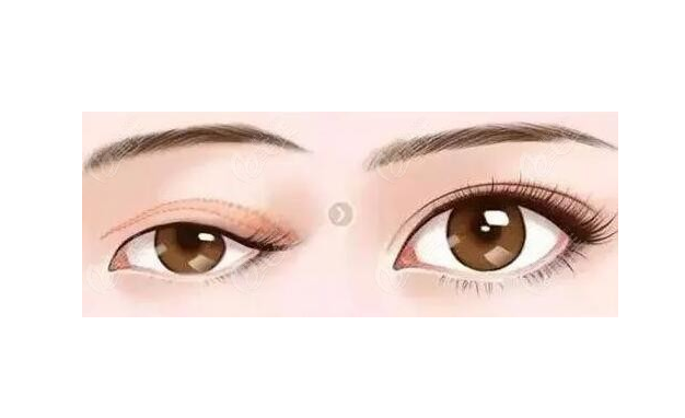 徐州二院哪個醫(yī)生做雙眼皮好？陶常波、張愛君等實力過硬