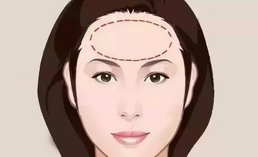 喬雅登雅致適合做哪些部位？皺紋拜拜|玻尿酸去抬頭紋案例附上