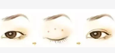 雙眼皮9 (2).png 雙眼皮9 (2).png