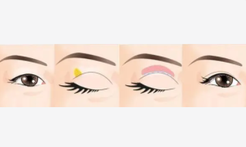 雙眼皮15 (2).png 雙眼皮15 (2).png