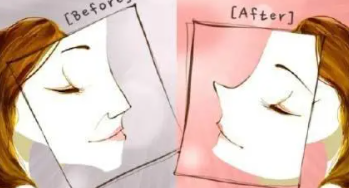 隆鼻7.png 隆鼻7.png