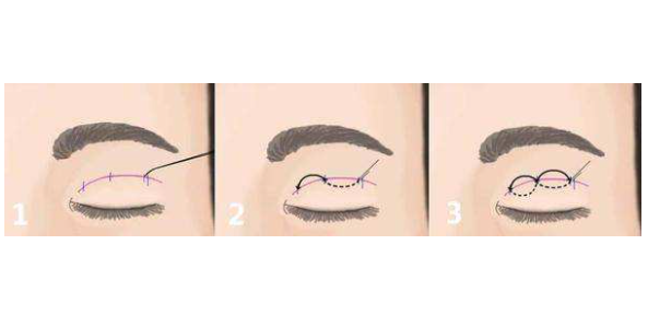 雙眼皮15.png 雙眼皮15.png