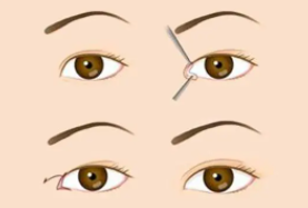 雙眼皮11.png 雙眼皮11.png